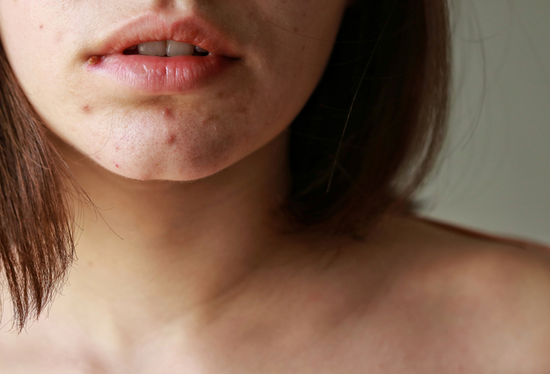 Acne: entenda quais são as causas e como lidar com ela